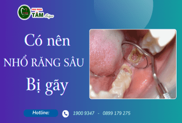 CÓ NÊN NHỔ RĂNG SÂU BỊ GÃY