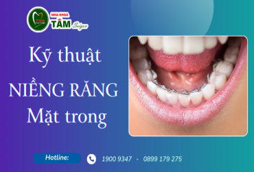 KỸ THUẬT NIỀNG RĂNG MẶT TRONG 