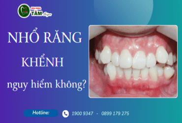 NHỔ RĂNG KHỂNH NGUY HIỂM KHÔNG?