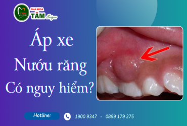 ÁP XE NƯỚU RĂNG CÓ NGUY HIỂM KHÔNG?