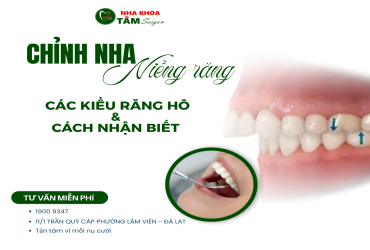 CÁC KIỂU RĂNG HÔ VÀ CÁCH NHẬN BIẾT 