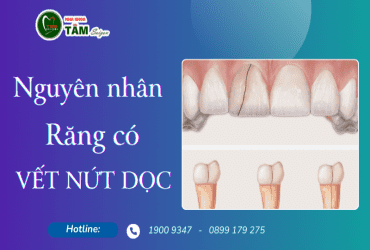 NGUYÊN NHÂN RĂNG CÓ VẾT NỨT DỌC 