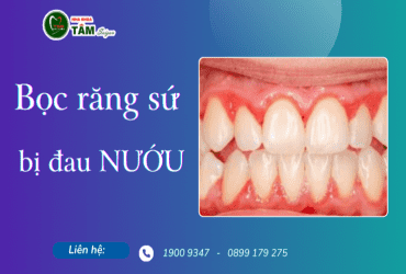 BỌC RĂNG SỨ BỊ ĐAU NƯỚU 