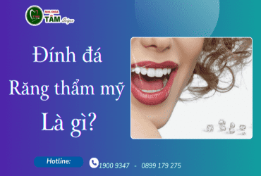 ĐÍNH ĐÁ RĂNG THẨM MỸ LÀ GÌ?