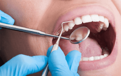 TẦM QUAN TRỌNG CỦA LẤY VÔI RĂNG  ĐỊNH KỲ 