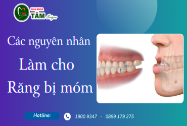 CÁC NGUYÊN NHÂN LÀM CHO RĂNG BỊ MÓM 