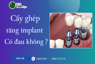 CẤY GHÉP RĂNG IMPLANT CÓ ĐAU KHÔNG? 