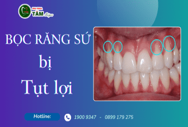 BỌC RĂNG SỨ BỊ TỤT LỢI 