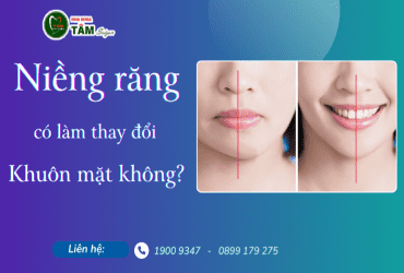 NIỀNG RĂNG CÓ LÀM THAY ĐỔI KHUÔN MẶT KHÔNG?