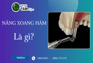 NÂNG XOANG HÀM LÀ GÌ?