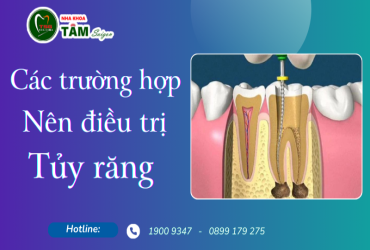 CÁC TRƯỜNG HỢP NÊN ĐIỀU TRỊ TỦY RĂNG 