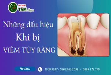 NHỮNG DẤU HIỆU CỦA VIÊM TỦY RĂNG 