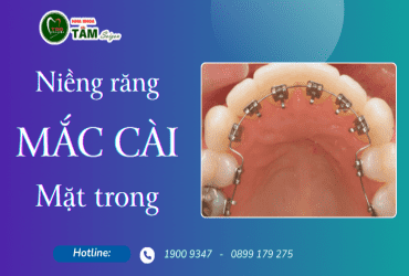 NIỀNG RĂNG MẮC CÀI MẶT TRONG 