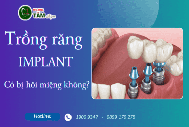 TRỒNG RĂNG IMPLANT CÓ BỊ HÔI MIỆNG KHÔNG?