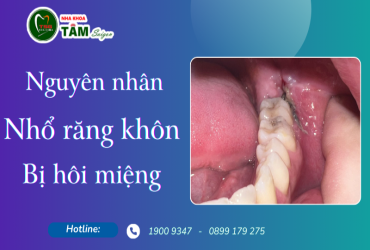 NGUYÊN NHÂN NHỔ RĂNG KHÔN BỊ HÔI MIỆNG 