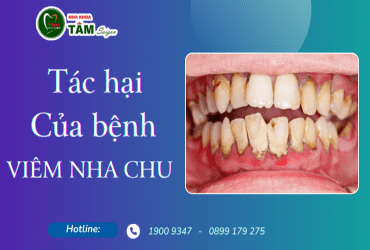 TÁC HẠI CỦA BỆNH VIÊM NHA CHU