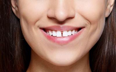 TRÁM RĂNG BỊ THƯA CÓ ĐƯỢC KHÔNG?