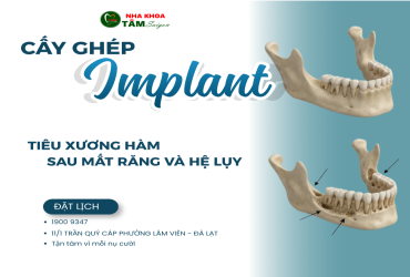 TIÊU XƯƠNG HÀM SAU MẤT RĂNG VÀ NHỮNG HỆ LỤY KHÔNG MONG MUỐN
