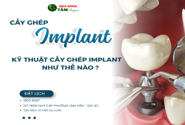 KỸ THUẬT CẤY GHÉP IMPLANT NHƯ THẾ NÀO?