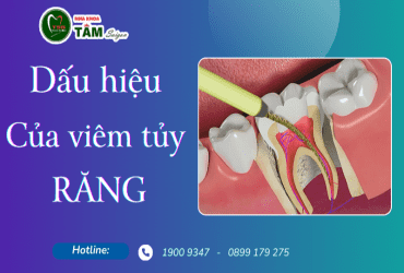 DẤU HIỆU CỦA VIÊM TỦY RĂNG 