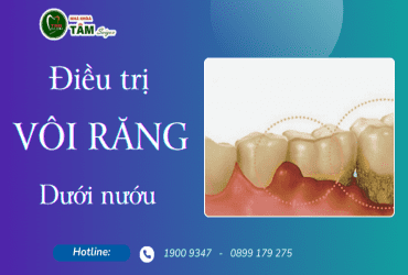 LẤY CAO RĂNG DƯỚI NƯỚU 