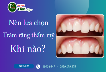 NÊN LỰA CHỌN TRÁM RĂNG THẨM MỸ KHI NÀO?