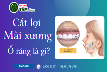 CẮT LỢI MÀI XƯƠNG Ổ RĂNG LÀ GÌ?