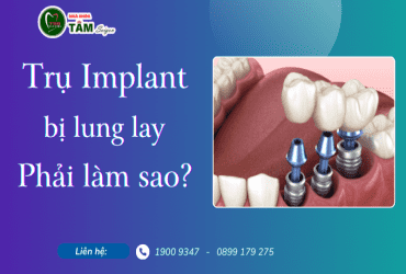 TRỤ IMPLANT BỊ LUNG LAY PHẢI LÀM SAO? 