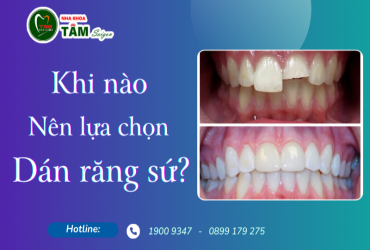 KHI NÀO NÊN LỰA CHỌN DÁN RĂNG SỨ?