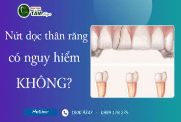 NỨT DỌC THÂN RĂNG CÓ NGUY HIỂM KHÔNG?