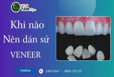 KHI NÀO NÊN DÁN RĂNG SỨ VENEER 