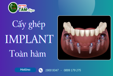 CẤY GHÉP IMPLANT TOÀN HÀM 