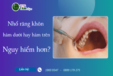 NHỔ RĂNG KHÔN HÀM TRÊN HAY HÀM DƯỚI NGUY HIỂM HƠN? 