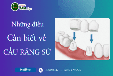 NHỮNG ĐIỀU CẦN BIẾT VỀ CẦU RĂNG SỨ 