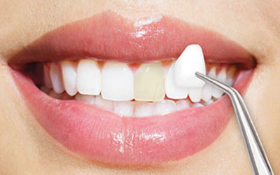 Dán sứ Veneer