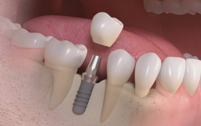 Cấy ghép Implant 