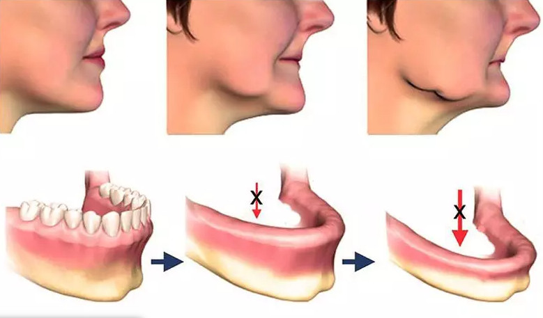 Mô phỏng hậu quả của tiêu xương hàm
