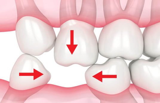 Hình ảnh mô phỏng xô lệch hàm do mất răng