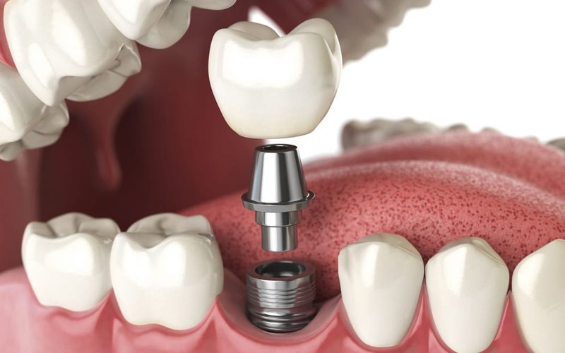 Mô phỏng trụ implant được cấy ghép