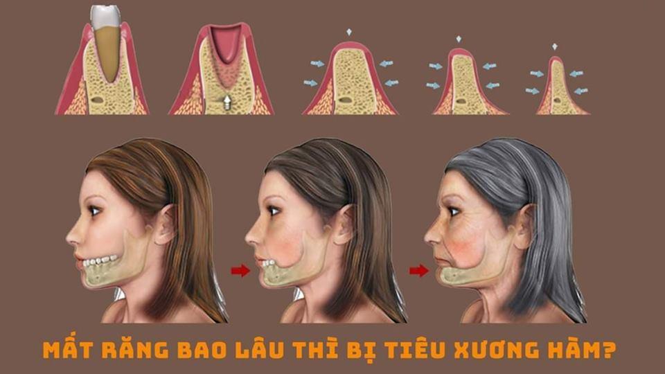 tiêu xuong hàm tiến triển theo thời gian