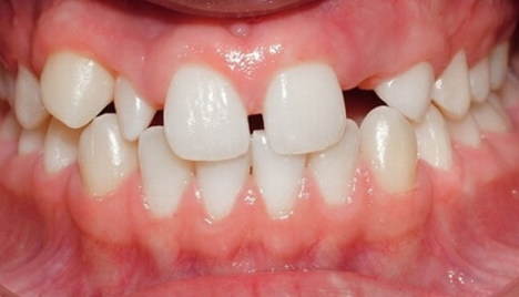 6 thói quen khiến răng bị thưa - Nha Khoa Tâm Sài Gòn