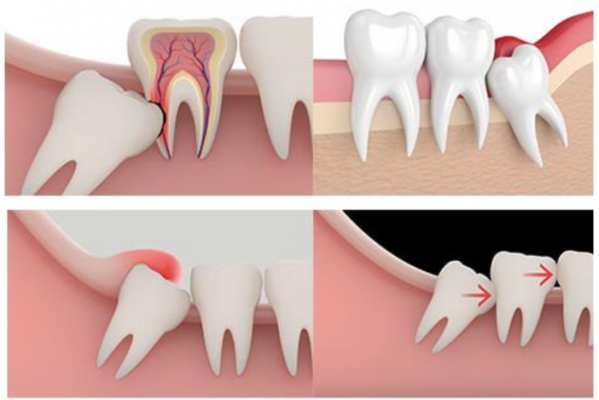 Răng khôn là những chiếc răng mọc cuối cùng và quá trình mọc thường gây ra nhiều triệu chứng như đau nhức, sưng nướu, sốt khiến người bệnh chỉ muốn nhổ bỏ. Vậy thực sự có nên nhổ răng khôn hay không? Cùng tìm hiểu trong bài viết dưới đây để hiểu hơn về vấn đề này!